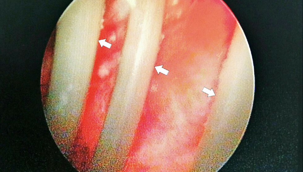 Foreign body: cystoscopy revealed a tubular body (shown by arrows) and congestion in the bladder mucosa. Photo: Dr. Sutomo General Hospital