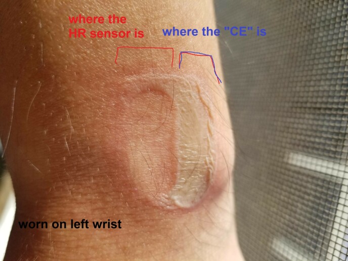 "Exploded: Reddit user throwd_away8675309 claimed that his Fitbit Versa exploded while using it, burning his wrist.  The post he shared is now part of the lawsuit against Fitbit.  Photo: Reddit