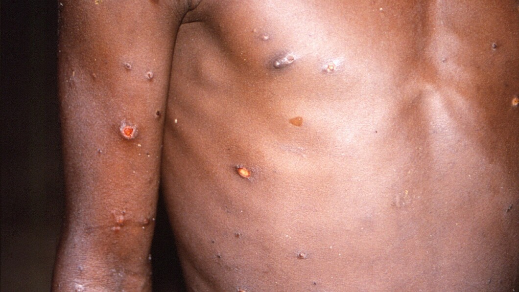 New cases: Monkeypox viral disease causes a rash that begins on the face and then spreads to the rest of the body Image: CDC/BRIAN WJ MAHY